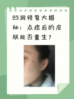 凹洞修复大揭秘：点痣后的皮肤能否重生？