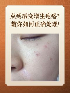 点痣后变增生疙瘩？教你如何正确处理！