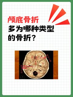 颅底骨折多为哪种类型的骨折？