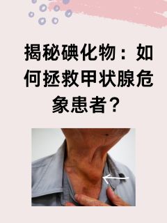 揭秘碘化物：如何拯救甲状腺危象患者？