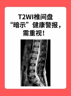 T2WI椎间盘“暗示”健康警报，需重视