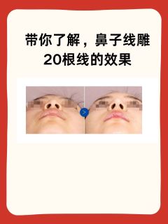 带你了解，鼻子线雕20根线的效果