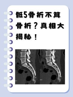 骶5骨折不算骨折？真相大揭秘！