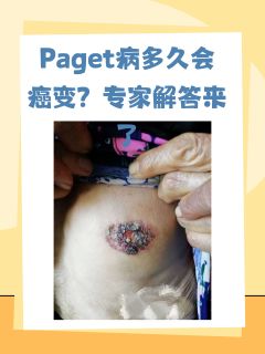 Paget病多久会癌变？专家解答来了