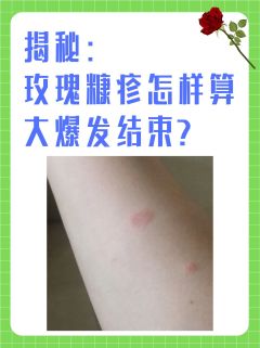 玫瑰糠疹怎样算大爆发结束？