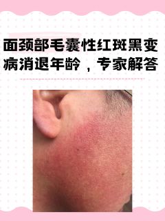 面颈部毛囊性红斑黑变病消退年龄，专家解答