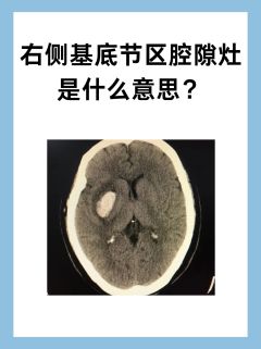 右侧基底节区腔隙灶是什么意思？