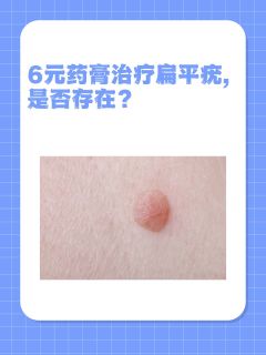 6元药膏治疗扁平疣，是否存在？