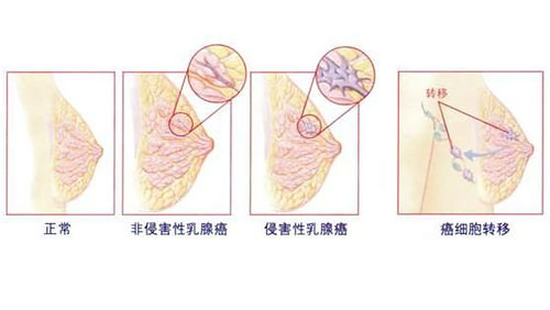 乳腺癌是如何分期的？